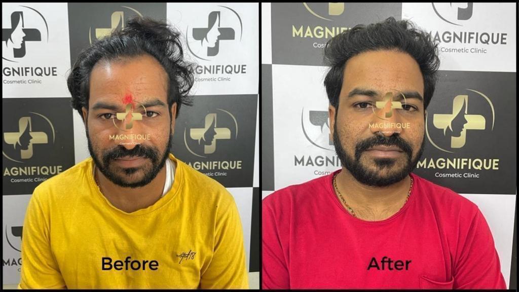 Before After 1