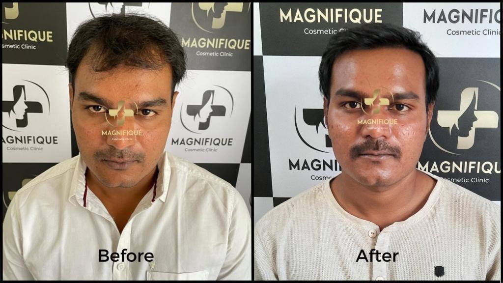 Before After 2