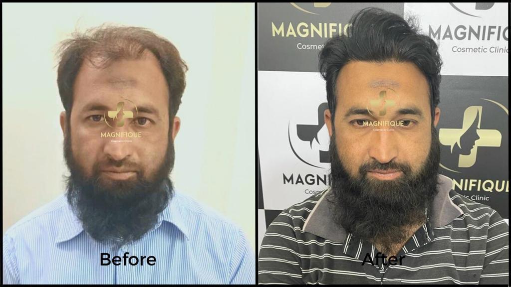 Before After 3